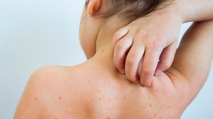 Question Your World: Can Virginians Get Measles?