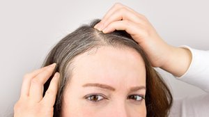 Alopecia Areata: The Medical Condition Explained