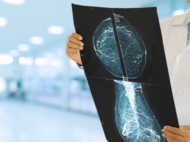 A photograph of a person in a while lab coat reviewing a see-through film. The person is supposed to be a doctor looking at a black scan of a breast searching for cancer.